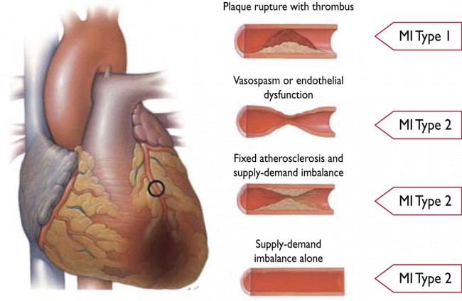 AVOID: Oxygen Potentially Problematic for Normoxic Patients with STEMI