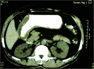Non-traumatic intramural hematomas in patients on anticoagulant therapy
