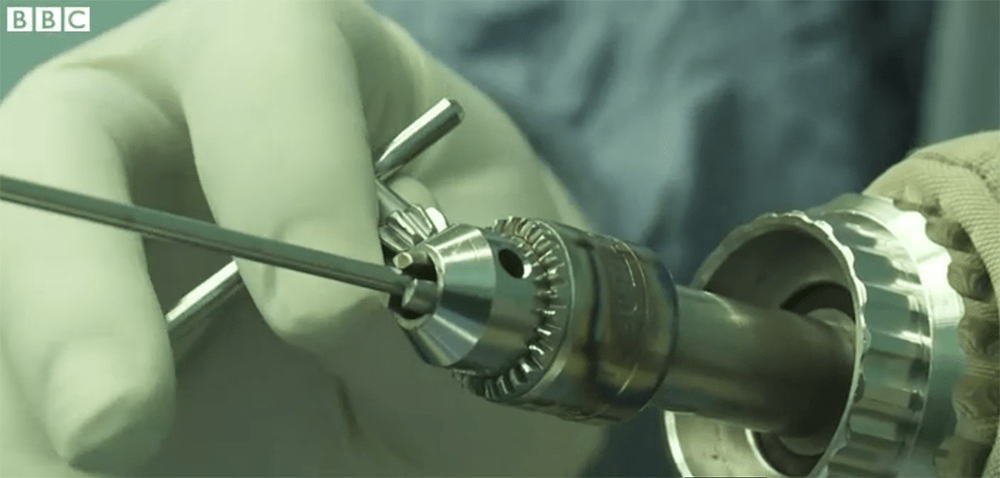 Fixing bones with a power drill? Less expensive and ingenious