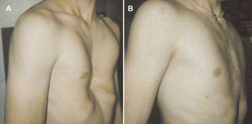 CPR in pectus excavatum patients: Is it time to say more?
