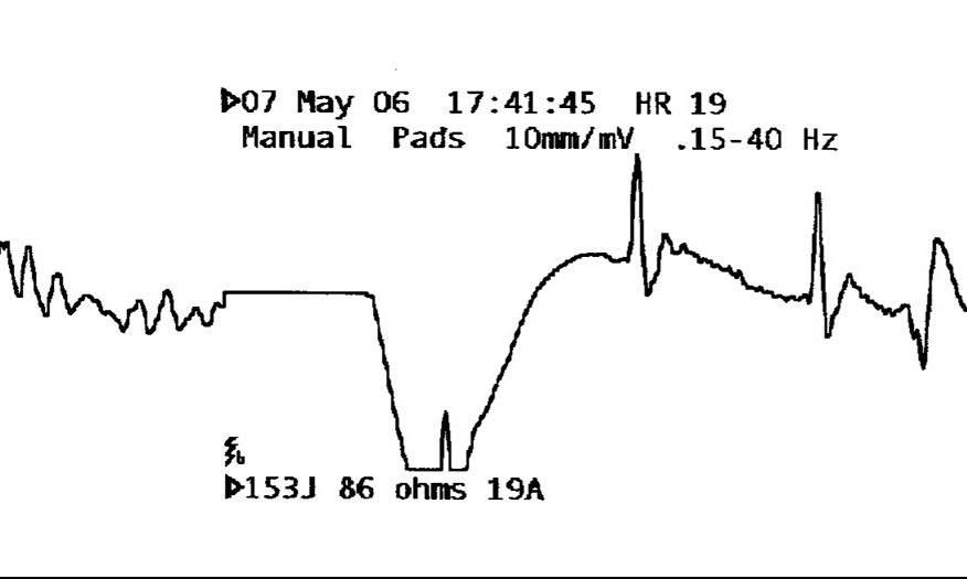 Drug therapy for typical arrhythmias in emergency patients