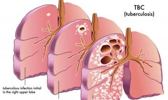 Multidrug resistant Tubercolosis in Europe, 2011 studies