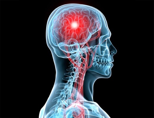 Prehospital Stroke Care
