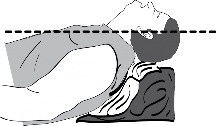 Head-Up Intubation: Head-Elevated patient positioning decreases complications of emergent tracheal intubation