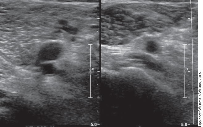 DVT ultrasound fails too – Is it enough to detect real disease?
