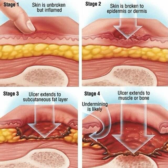 Wound care guideline (part 3) Pressure wound dressing