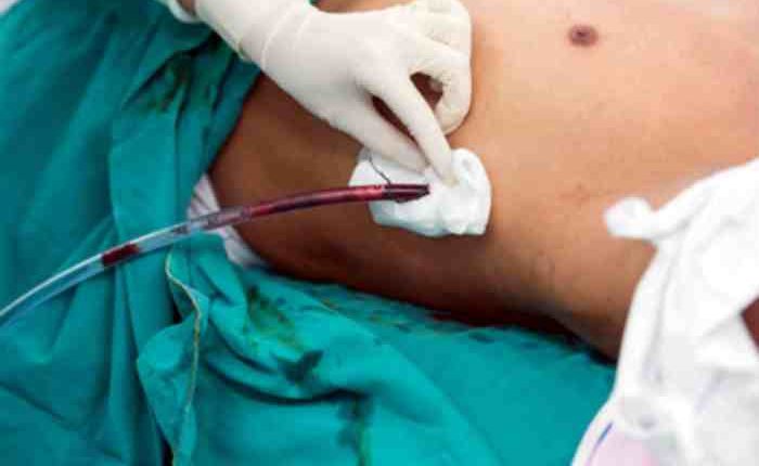 Il drenaggio toracico in emergenza sanitaria | Emergency Live