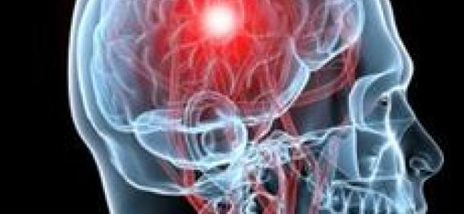 Brescia: Giornata Mondiale contro l'Ictus, incontro sulla prevenzione | Emergency Live