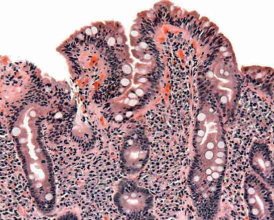 La didattica intestinale in urgenza - EMPills | Emergency Live