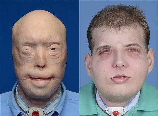 Ustioni, il primo trapianto di volto al mondo con l'utilizzo di una stampante 3D | Emergency Live 6