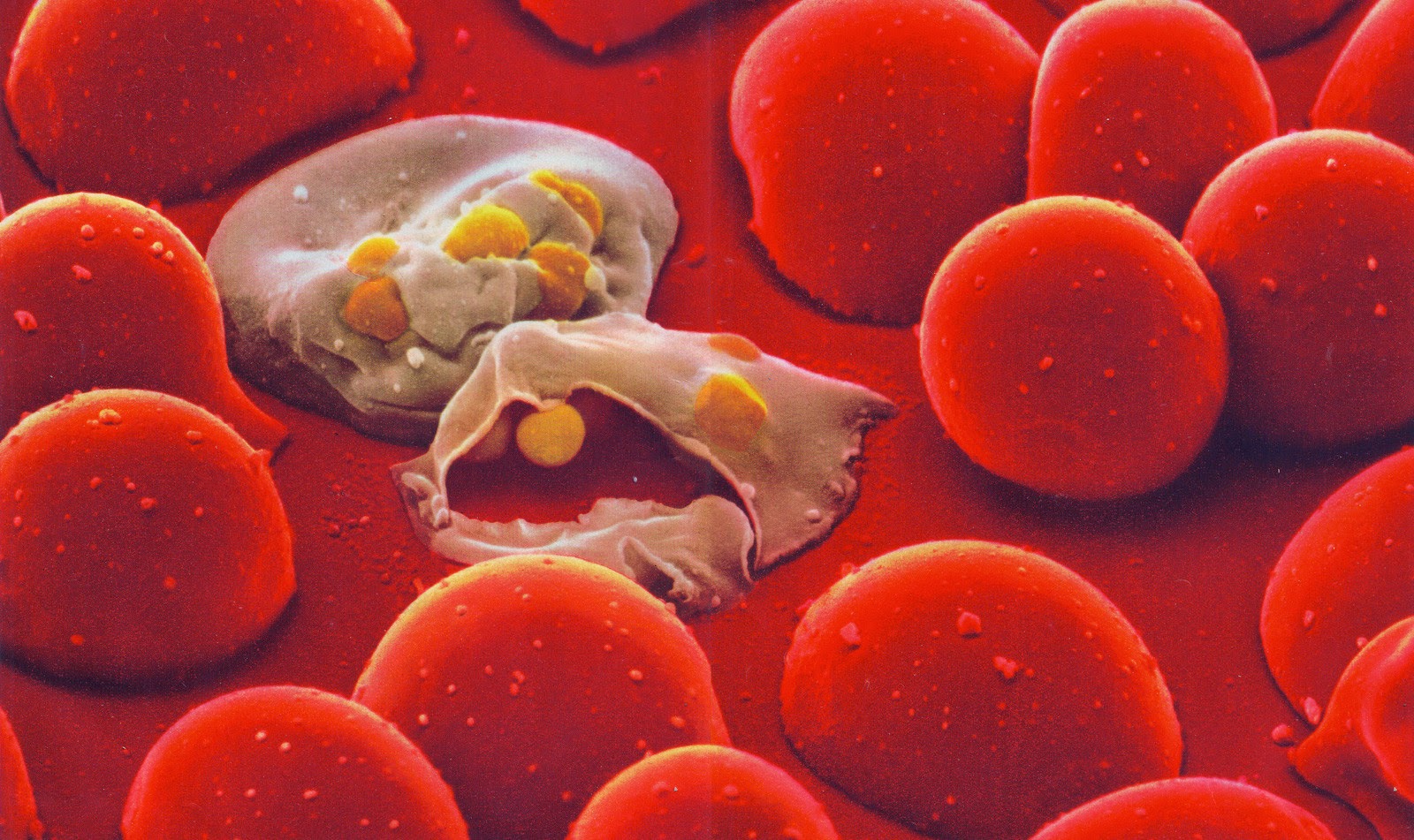 ITALIA - La malaria torna a far paura | Emergency Live