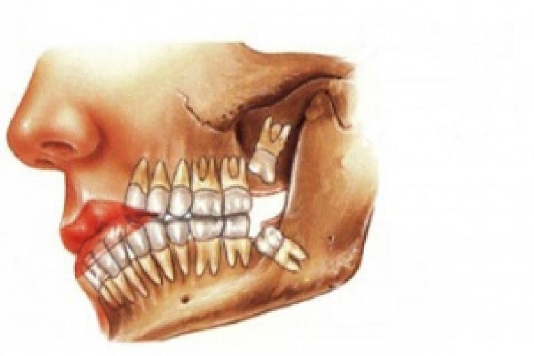 Dente del giudizio Emergency Live
