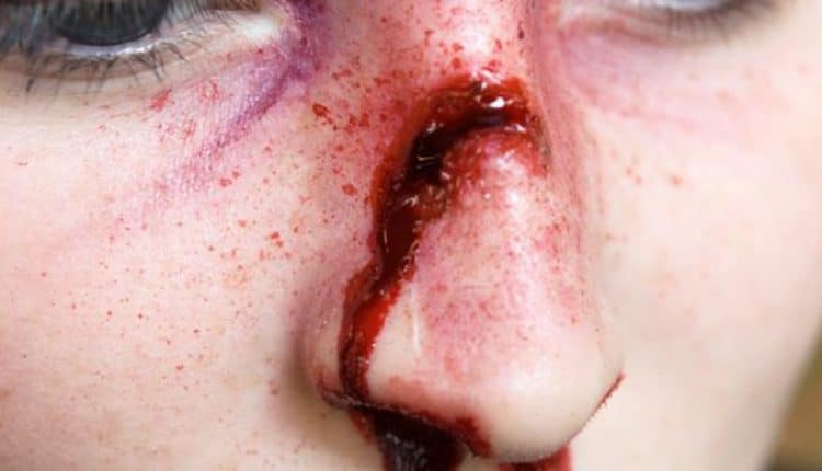 Violenza sui soccorritori, Napoli raddoppia: testata all'infermiere perché non vuole ospedalizzare dove vuole il paziente | Emergency Live
