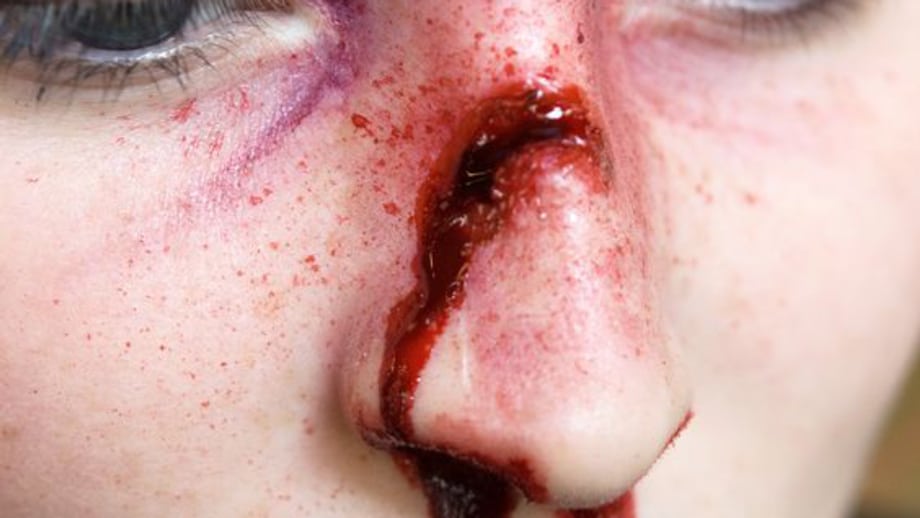 Violenza sui soccorritori, Napoli raddoppia: testata all'infermiere perché non vuole ospedalizzare dove vuole il paziente | Emergency Live