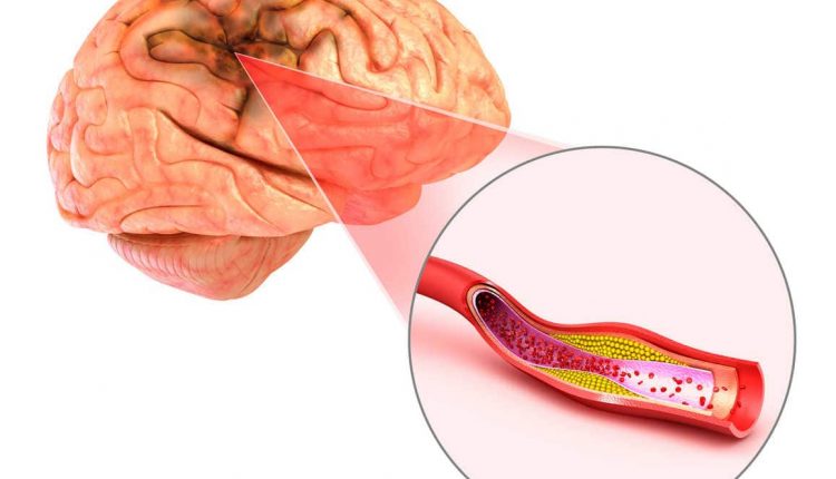 Ischemia cerebrale, cosa accade al nostro cervello quando non arriva abbastanza sangue? | Emergency Live