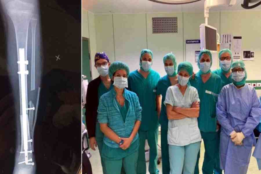 Ricostruita caviglia a una bimba con l’osso di un donatore e un chiodo ‘allungabile’: è la prima volta al mondo | Emergency Live
