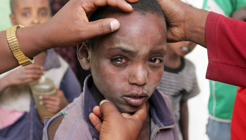 Etiopia contro il tracoma: CBN Italia si allea con AICS per portare cura e conoscenza della malattia | Emergency Live