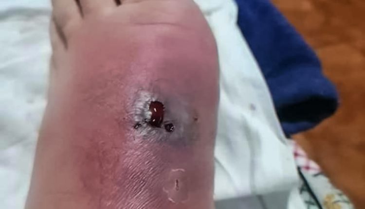 Ragno violino, un altro caso: morso operaio a Mirandola, il ragno era entrato nella scarpa | Emergency Live 1