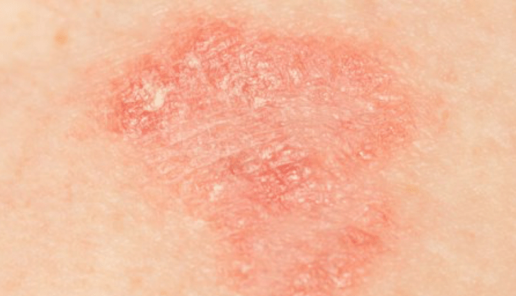 Giornata internazionale della dermatite atopica: la malattia colpisce 35mila italiani. Il parere degli esperti | Emergency Live