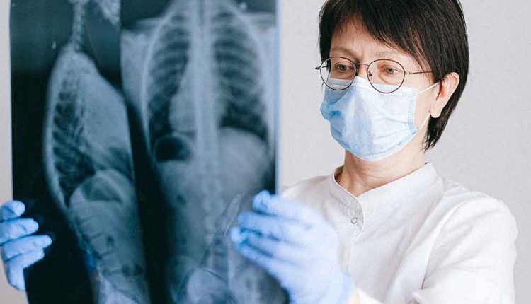 Fibrosi cistica, tra febbraio e luglio solo 21 pazienti positivi al Covid-19 | Emergency Live 2