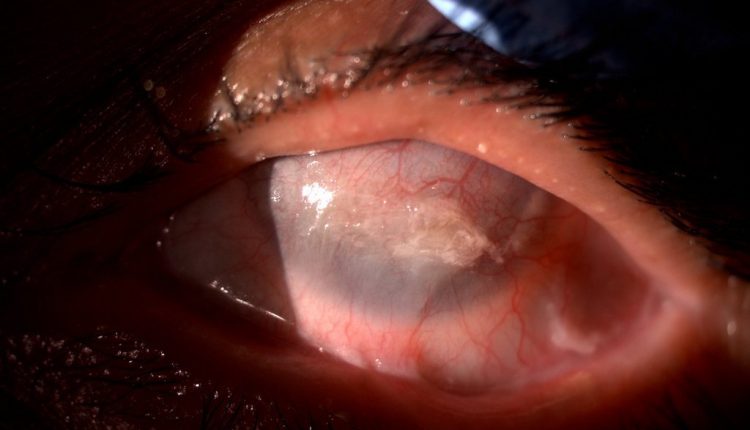 Il Myanmar ha vinto contro il tracoma: le congratulazioni dell'OMS al paese asiatico | Emergency Live