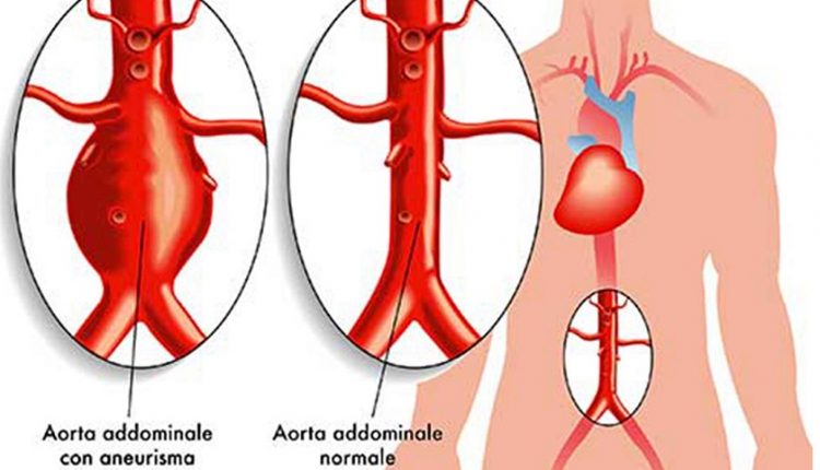 Aneurisma dell’aorta addominale: riconoscerlo significa salvare una vita | Emergency Live