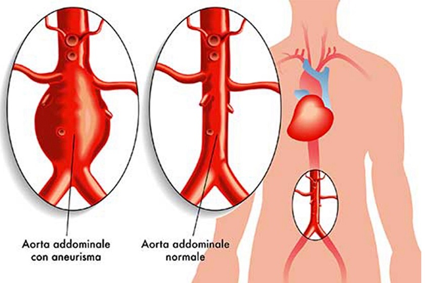 Aneurisma dell’aorta addominale: riconoscerlo significa salvare una vita | Emergency Live