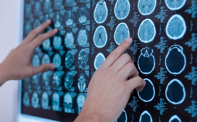 Tumori Cerebrali. I gliomi: cosa sono e come riconoscerli | Emergency Live