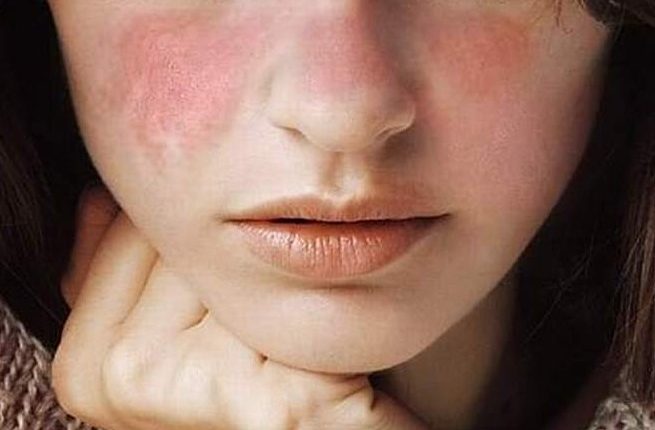 Lupus Eritematoso Sistemico (LES): con quali sintomi si manifesta?