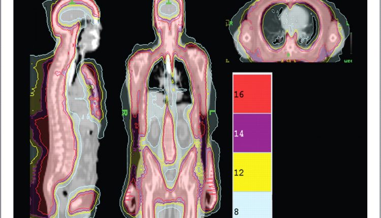 Total Marrow Irradiation (TMI) e leucemia: in cosa consiste e perché si esegue la radioterapia prima del trapianto di midollo | Emergency Live