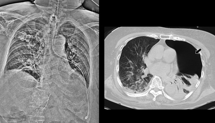 Pneumotorace indotto dall'errato inserimento di un sondino nasogastrico: un case report | Emergency Live