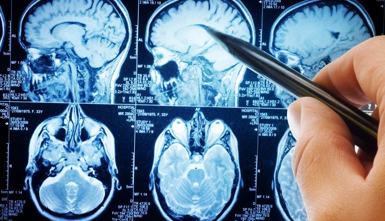 Le nuove tecniche di risonanza magnetica per l’asportazione totale dei tumori cerebrali: uno studio Humanitas | Emergency Live