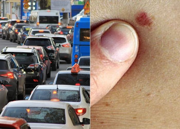 Tumori della pelle, i dermatologi: “anche l’inquinamento fa la sua parte” | Emergency Live