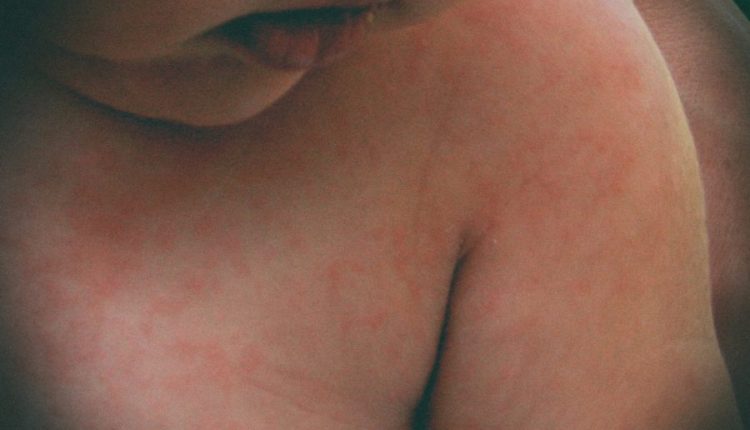 Istituto Superiore di Sanità: da aprile ad oggi in Italia nessun caso di morbillo e rosolia
