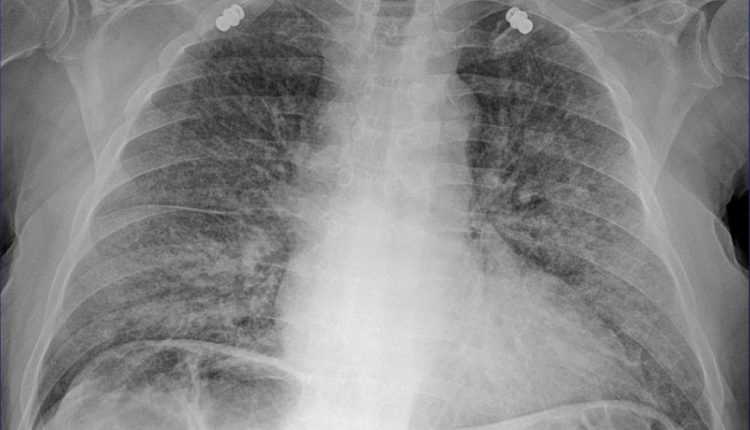 Polmonite da COVID-19, lo studio dell'Università di Harvard sull'andamento bifasico dell'infezione