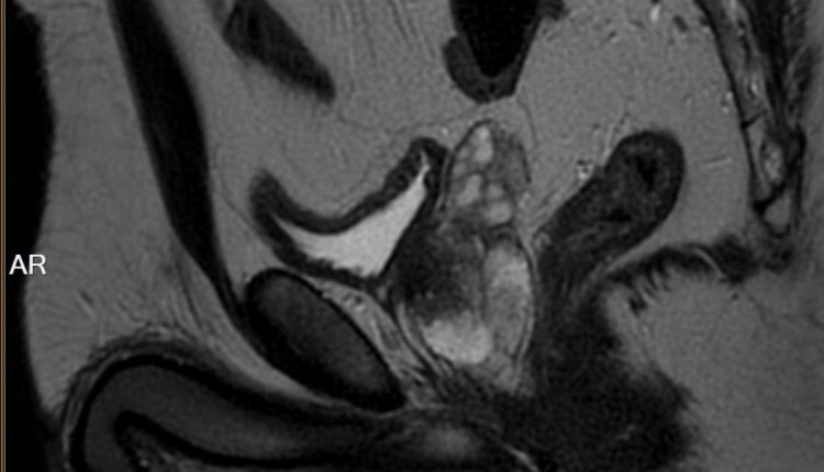 Diagnostica: la Risonanza Magnetica Multiparametrica della Prostata (RM mp)