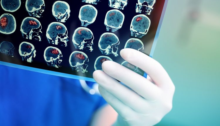 Primo soccorso, approccio al paziente Covid con stroke in atto. Mount Sinai conferma: ictus più gravi e con esito peggiore