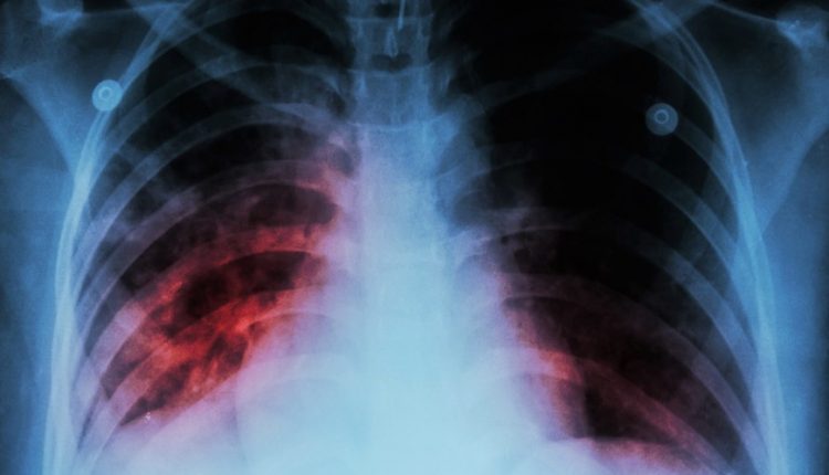 Prevenzione e cura della tubercolosi: studio CNR / ISS / Federico II sulla restrizione calorica controllata