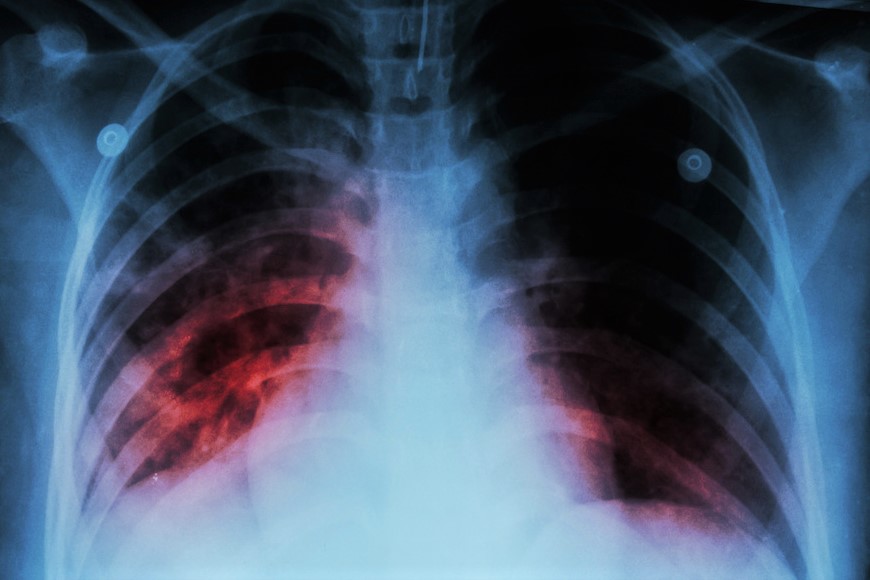 Prevenzione e cura della tubercolosi: studio CNR / ISS / Federico II sulla restrizione calorica controllata
