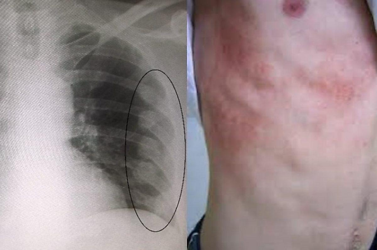 Fratture E Traumi Cosa Fare Quando Si Rompono O Si Incrinano Le Costole
