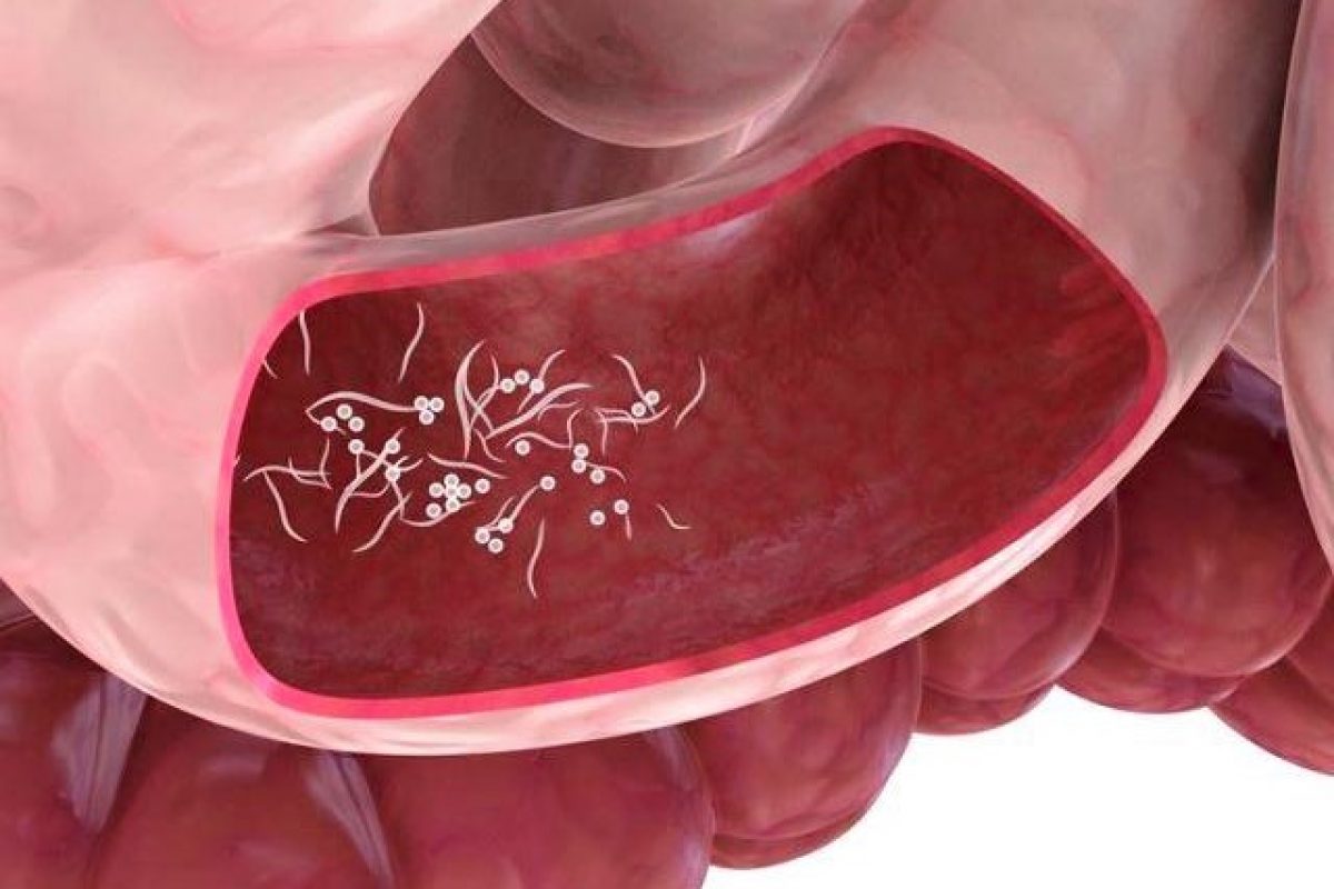 enterobius vermicularis bambini)