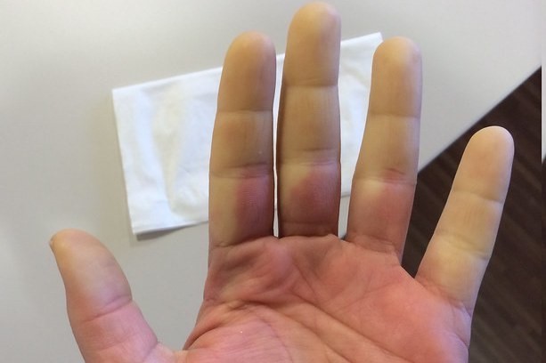 Sotto) Guanti contro la Sindrome di Raynaud, Acrocianosi e la Sclerod –  NOAcademy