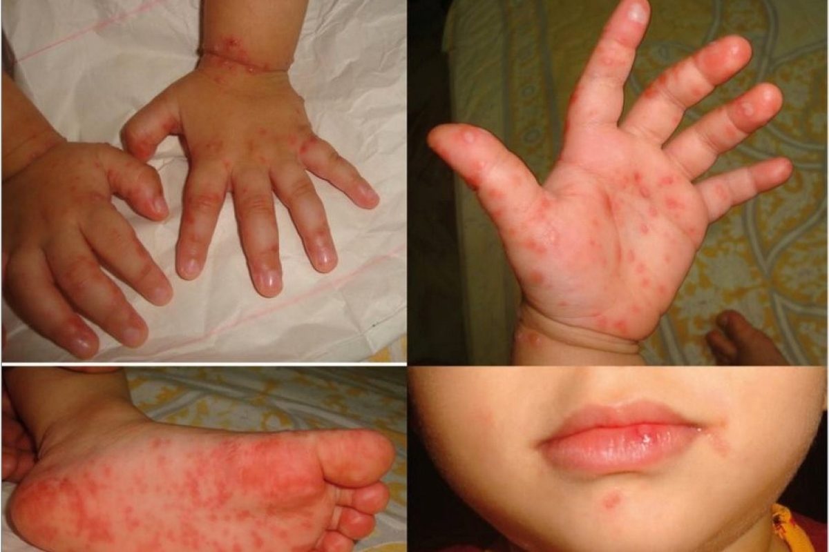 Pediatria, che cos'è la malattia mani piedi bocca - Emergency Live