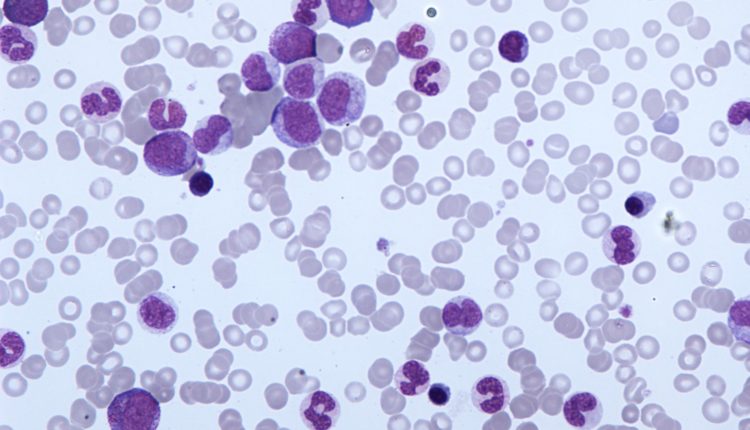 Che Tipo Di Tessuto è Il Sangue Cos'è la leucemia mielomonocitica cronica (CMML)?