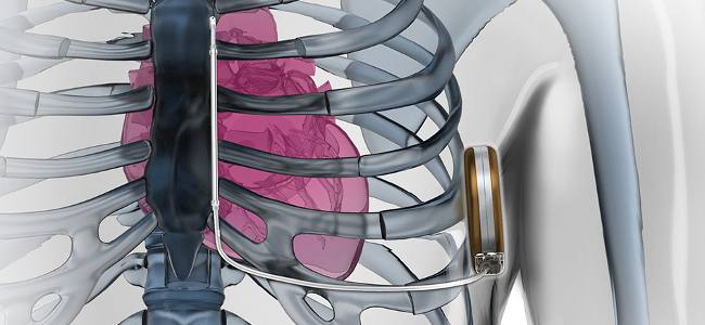 Emergency Live | Internal heart defibrillation is now possible in U.K.