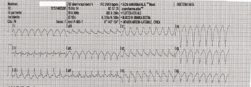 Emergency Live | ECG criteria, 3 simple rules from Ken Grauer - ECG recognize VT