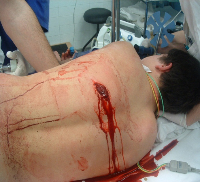 Emergency Live | Pain management in blunt thoracic trauma