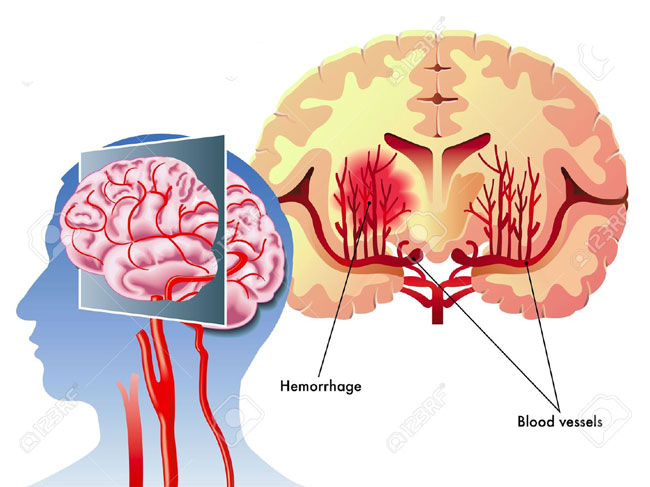 Emergency Live | 2015 guidelines for treating Intracerebral Hemorrage (ICH)