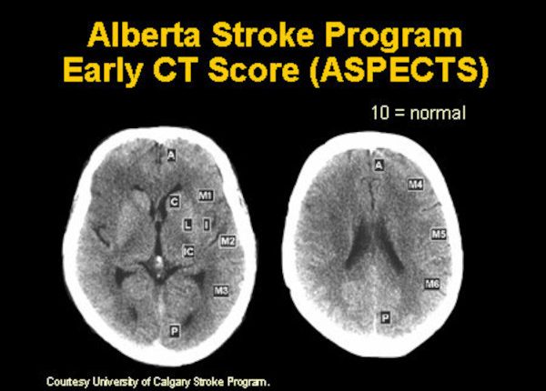 Emergency Live | First Automated Stroke Imaging Evaluation in a MSU