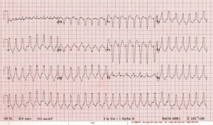 Kardiologai perspėja: nediagnozuoti širdies ritmo sutrikimai – tiksinti bomba
